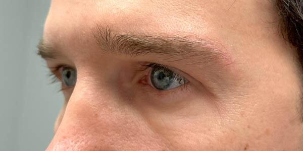 Brow Lift after at Gregory D. Lewen, MD Oculofacial Plastic Surgery in Aventura, FL