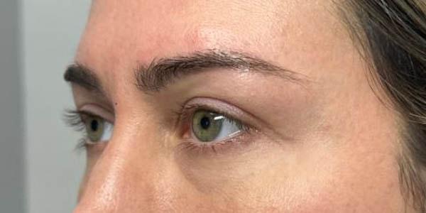 Gregory D. Lewen, MD Oculofacial Plastic Surgery blepharoplasty after — Aventura, FL