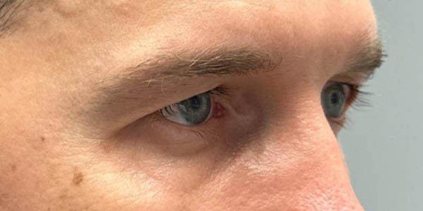 Brow Lift before at Gregory D. Lewen, MD Oculofacial Plastic Surgery in Aventura, FL