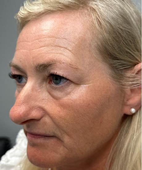 Brow Lift before at Gregory D. Lewen, MD Oculofacial Plastic Surgery in Aventura, FL