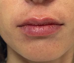 Gregory D. Lewen, MD Oculofacial Plastic Surgery lip filler after — Aventura, FL
