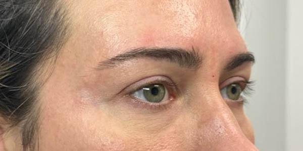 Gregory D. Lewen, MD Oculofacial Plastic Surgery blepharoplasty after — Aventura, FL