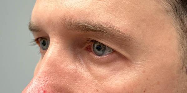 Brow Lift before at Gregory D. Lewen, MD Oculofacial Plastic Surgery in Aventura, FL