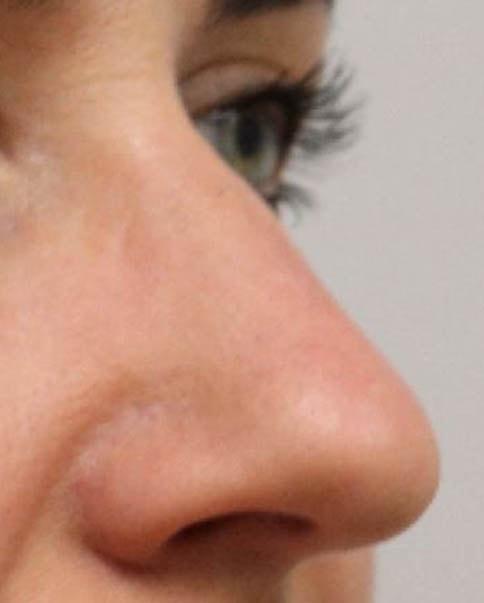 Liquid Rhinoplasty after at Gregory D. Lewen, MD Oculofacial Plastic Surgery in Aventura, FL