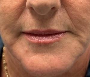 Gregory D. Lewen, MD Oculofacial Plastic Surgery lip filler after — Aventura, FL