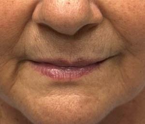 Lip Filler before at Gregory D. Lewen, MD Oculofacial Plastic Surgery in Aventura, FL