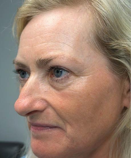 Brow Lift after at Gregory D. Lewen, MD Oculofacial Plastic Surgery in Aventura, FL