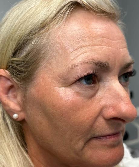 Brow Lift before at Gregory D. Lewen, MD Oculofacial Plastic Surgery in Aventura, FL