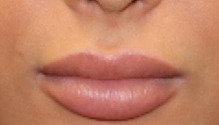 Gregory D. Lewen, MD Oculofacial Plastic Surgery lip filler after — Aventura, FL