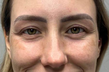 Botox before at Gregory D. Lewen, MD Oculofacial Plastic Surgery in Aventura, FL