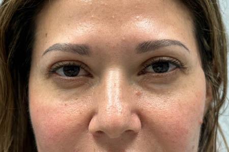 Gregory D. Lewen, MD Oculofacial Plastic Surgery blepharoplasty after — Aventura, FL