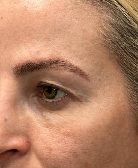 Brow Lift before at Gregory D. Lewen, MD Oculofacial Plastic Surgery in Aventura, FL
