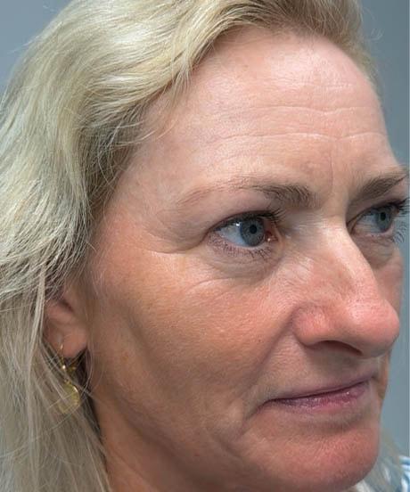 Brow Lift after at Gregory D. Lewen, MD Oculofacial Plastic Surgery in Aventura, FL