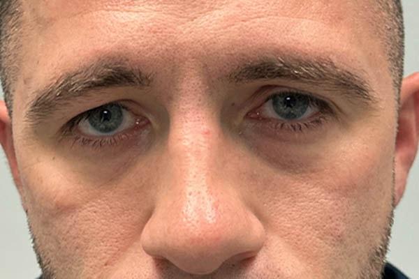 Juvederm before at Gregory D. Lewen, MD Oculofacial Plastic Surgery in Aventura, FL