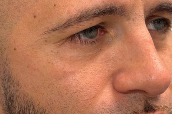 Juvederm after at Gregory D. Lewen, MD Oculofacial Plastic Surgery in Aventura, FL