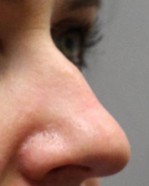 Liquid Rhinoplasty before at Gregory D. Lewen, MD Oculofacial Plastic Surgery in Aventura, FL