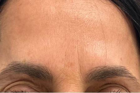 Botox after at Gregory D. Lewen, MD Oculofacial Plastic Surgery in Aventura, FL