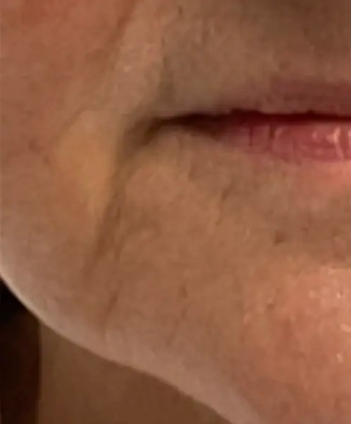 Morpheus8 after at Gregory D. Lewen, MD Oculofacial Plastic Surgery in Aventura, FL