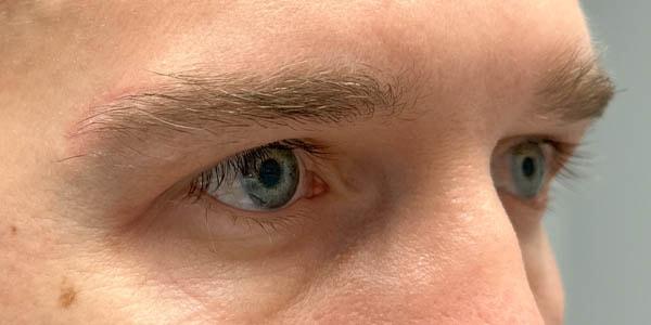 Brow Lift after at Gregory D. Lewen, MD Oculofacial Plastic Surgery in Aventura, FL