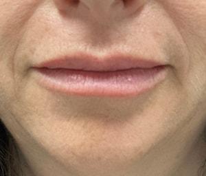 Gregory D. Lewen, MD Oculofacial Plastic Surgery lip filler after — Aventura, FL