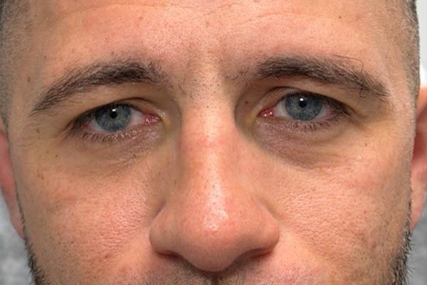 Juvederm after at Gregory D. Lewen, MD Oculofacial Plastic Surgery in Aventura, FL