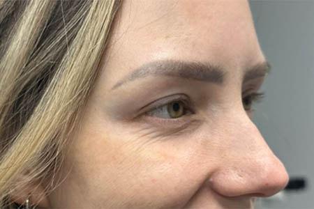 Botox after at Gregory D. Lewen, MD Oculofacial Plastic Surgery in Aventura, FL