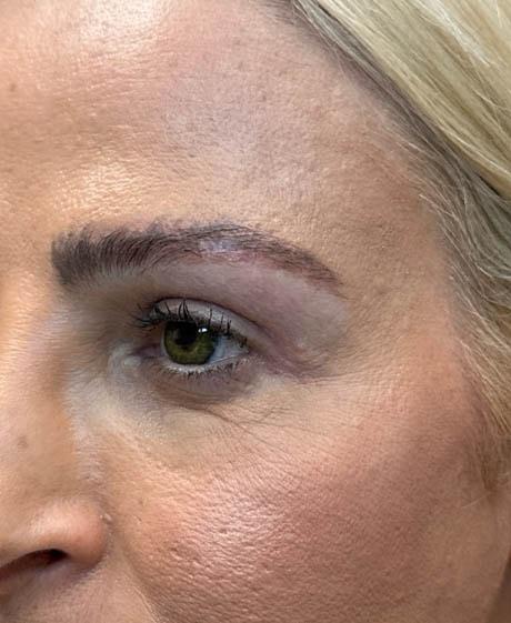 Brow Lift after at Gregory D. Lewen, MD Oculofacial Plastic Surgery in Aventura, FL
