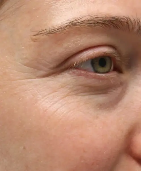 Morpheus8 before at Gregory D. Lewen, MD Oculofacial Plastic Surgery in Aventura, FL