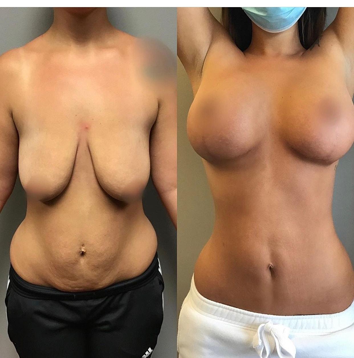 Unfiltered Cosmetic Surgery + Aesthetic Medicine mommy makeover result — Hinsdale, IL