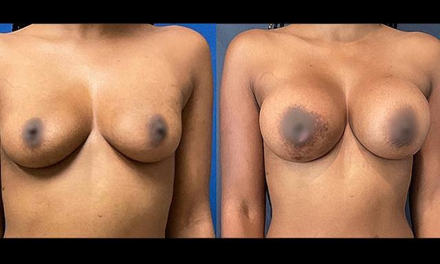 Breast Augmentation result at Unfiltered Cosmetic Surgery + Aesthetic Medicine in Hinsdale, IL