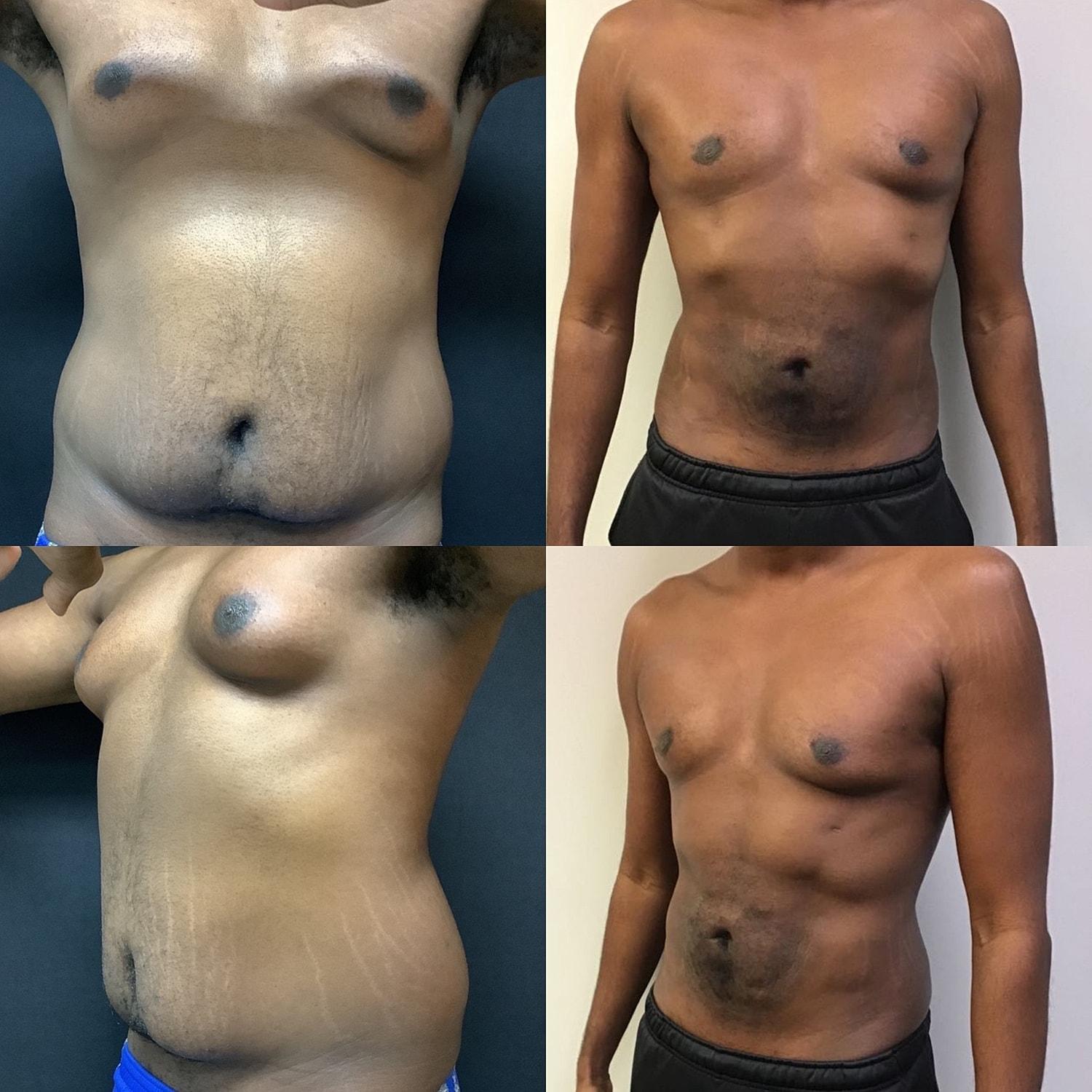 Unfiltered Cosmetic Surgery + Aesthetic Medicine liposuction result — Hinsdale, IL