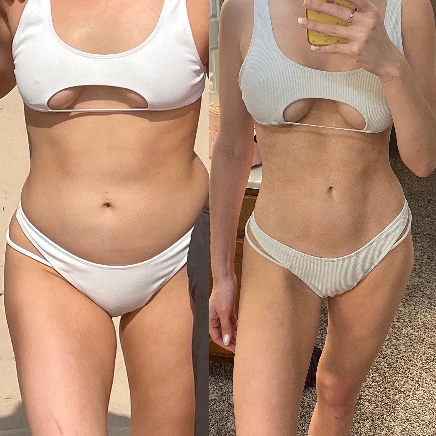 Unfiltered Cosmetic Surgery + Aesthetic Medicine liposuction result — Hinsdale, IL