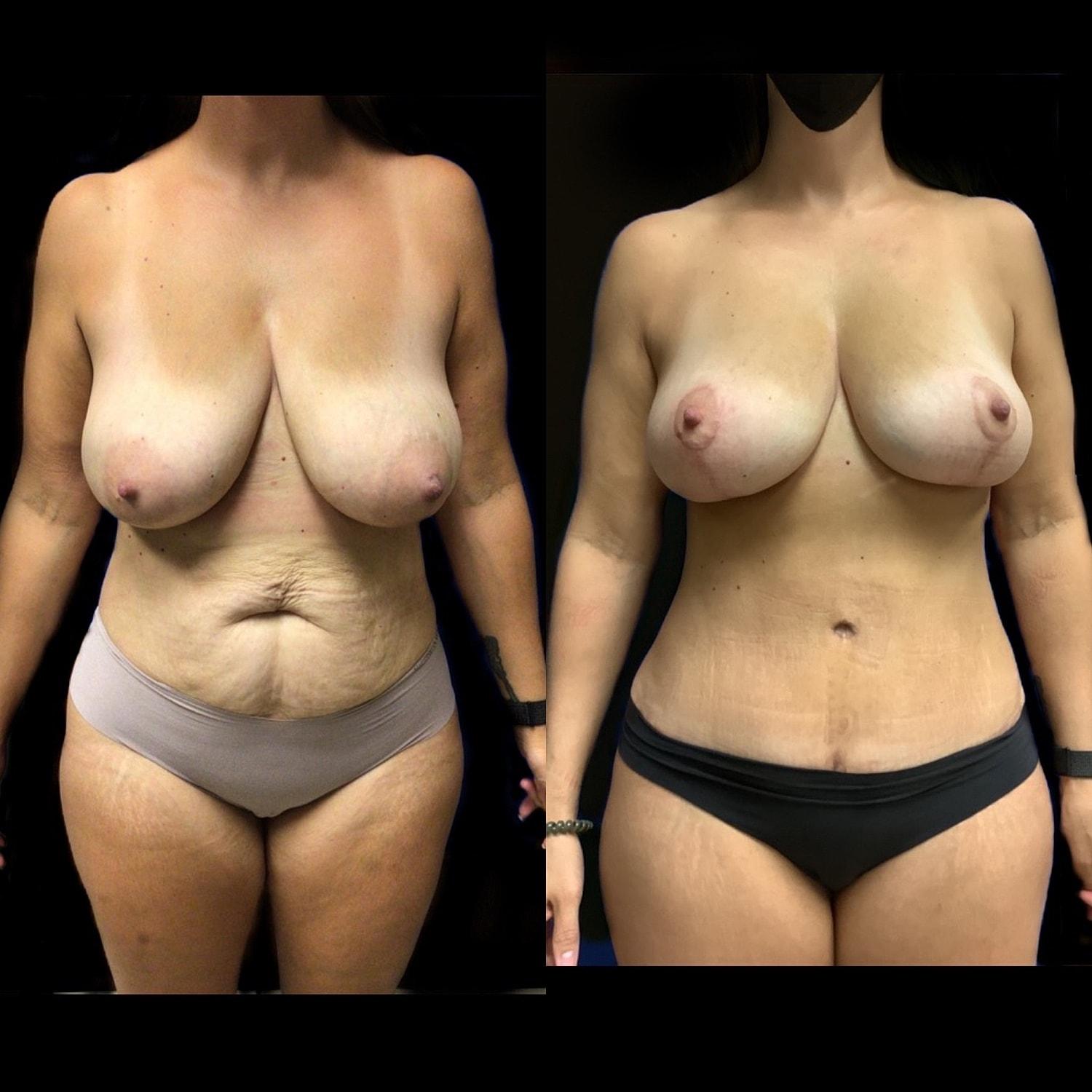 Unfiltered Cosmetic Surgery + Aesthetic Medicine mommy makeover result — Hinsdale, IL