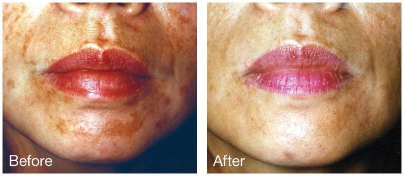 Epi Center MedSpa chemical peel result — San Francisco, CA