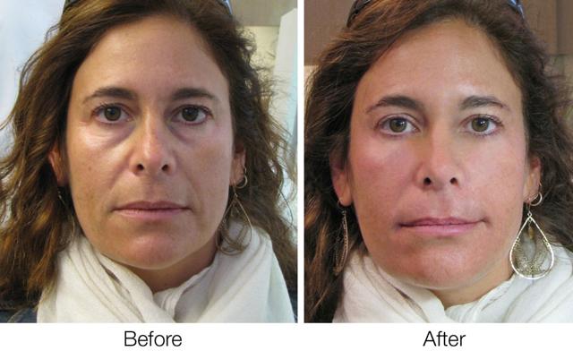 Microneedling result at Epi Center MedSpa in San Francisco, CA