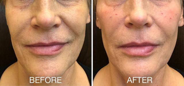 Microneedling result at Epi Center MedSpa in San Francisco, CA