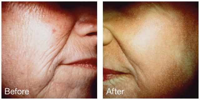 Microneedling result at Epi Center MedSpa in San Francisco, CA