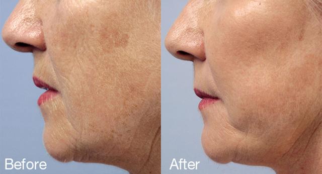 Microneedling result at Epi Center MedSpa in San Francisco, CA