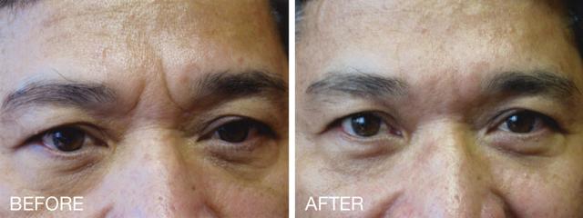 Botox result at Epi Center MedSpa in San Francisco, CA