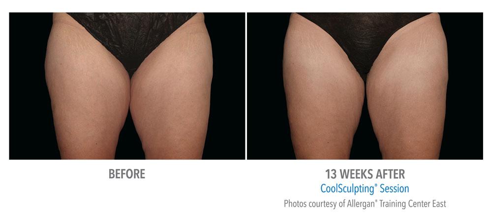 Epi Center MedSpa coolsculpting result — San Francisco, CA