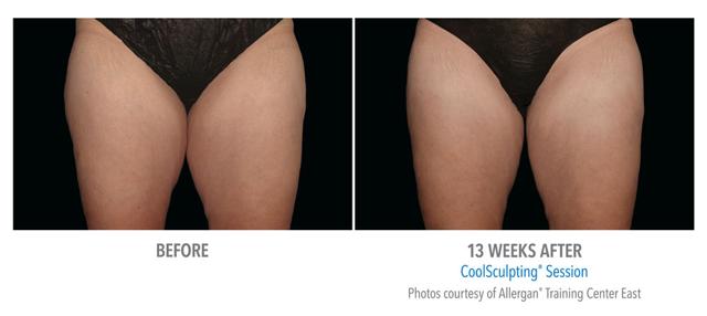 CoolSculpting result at Epi Center MedSpa in San Francisco, CA