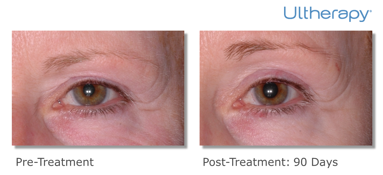 Epi Center MedSpa result — San Francisco, CA