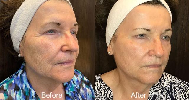 Microneedling result at Epi Center MedSpa in San Francisco, CA
