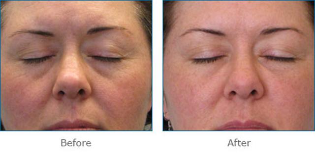 Microneedling result at Epi Center MedSpa in San Francisco, CA