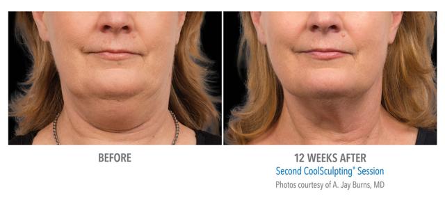 CoolSculpting result at Epi Center MedSpa in San Francisco, CA