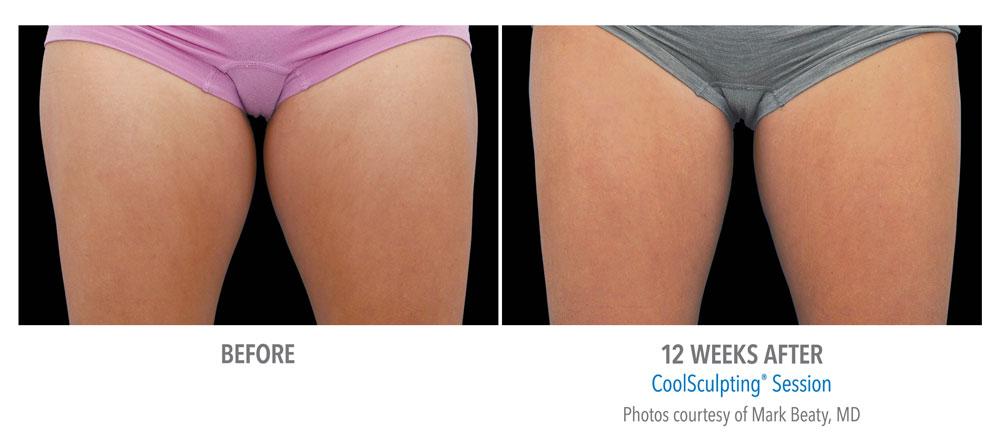 Epi Center MedSpa coolsculpting result — San Francisco, CA