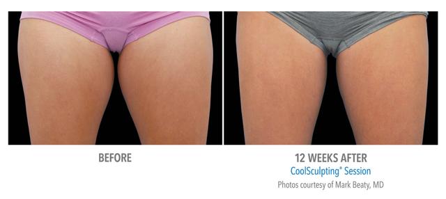 CoolSculpting result at Epi Center MedSpa in San Francisco, CA