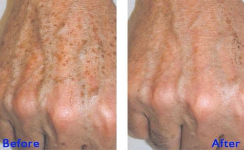 Epi Center MedSpa photofacial result — San Francisco, CA