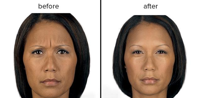 Botox result at Epi Center MedSpa in San Francisco, CA
