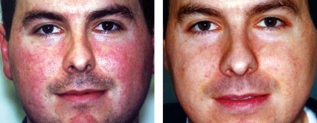 Laser Skin Resurfacing result at Epi Center MedSpa in San Francisco, CA